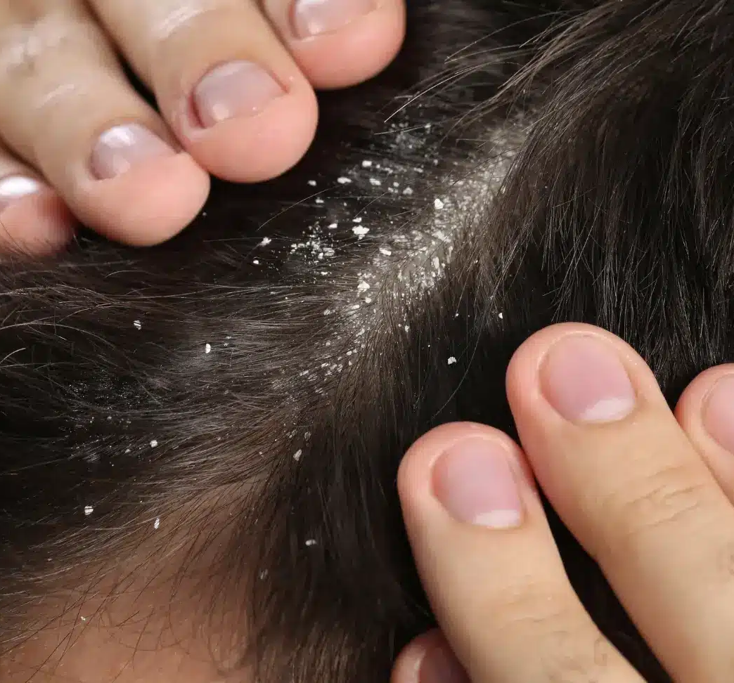 Dandruff concern
